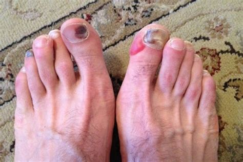 gnarly feet pics|These Are the Ugliest Runners Feet Youve Ever Seen